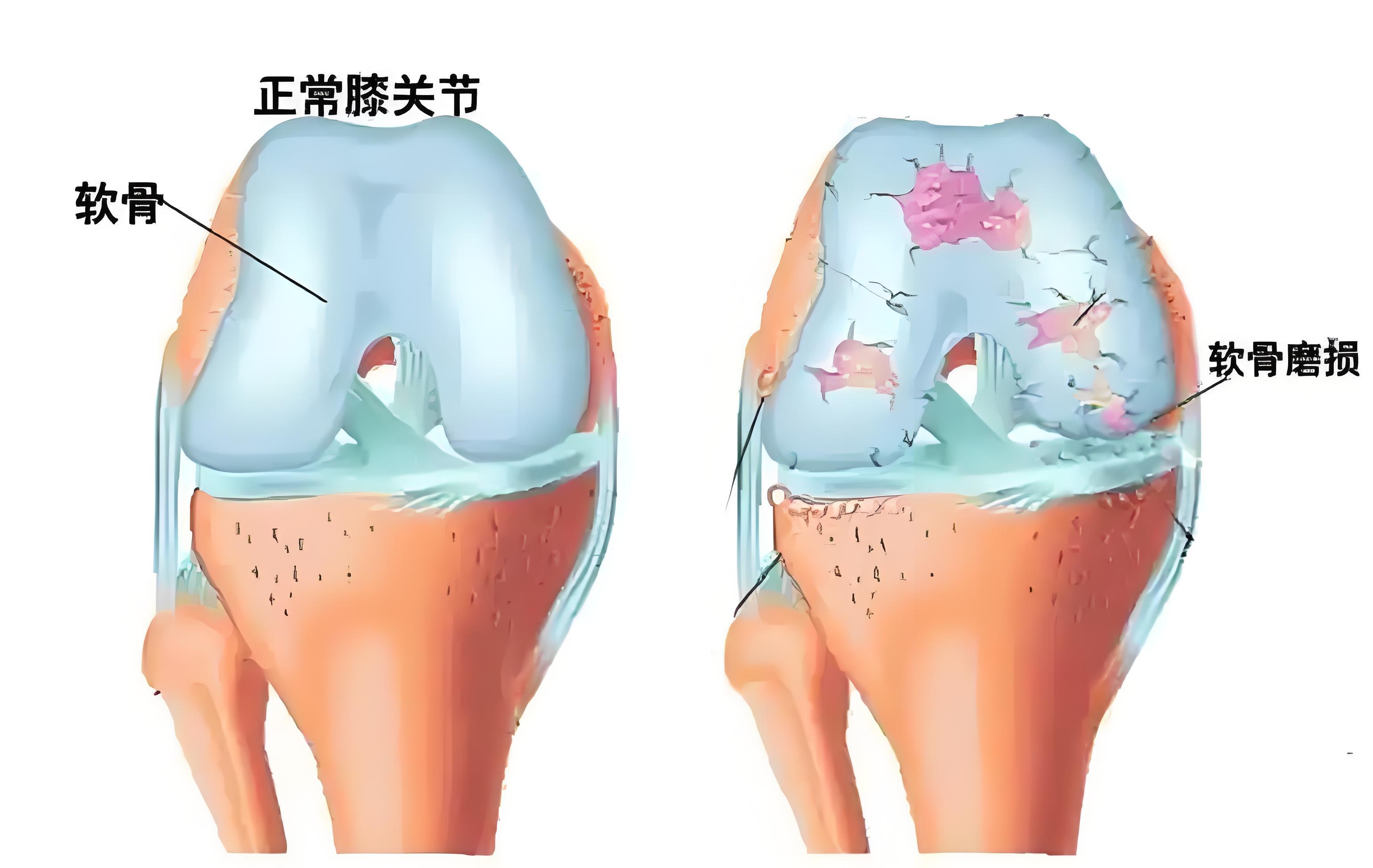 软骨症能治好吗