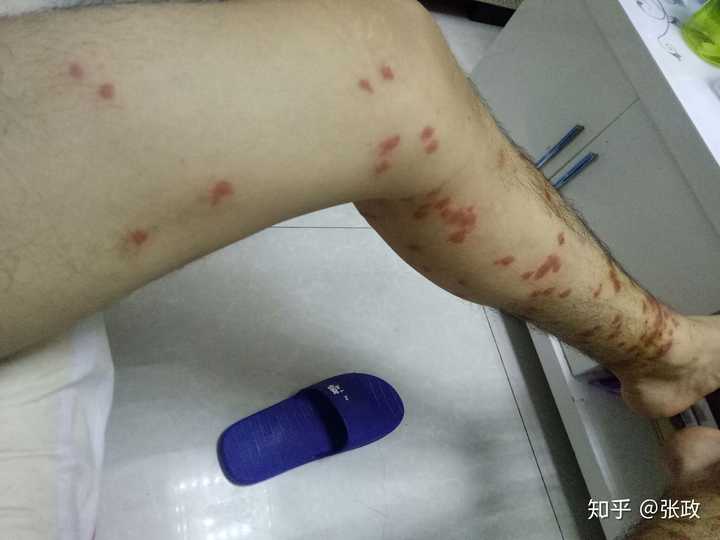 跳蚤爱咬什么样的人