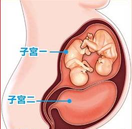 双子宫怀孕