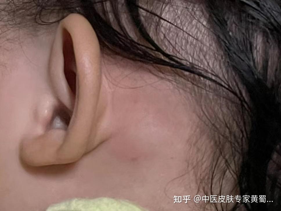 耳垂后面长了一个包是什么病