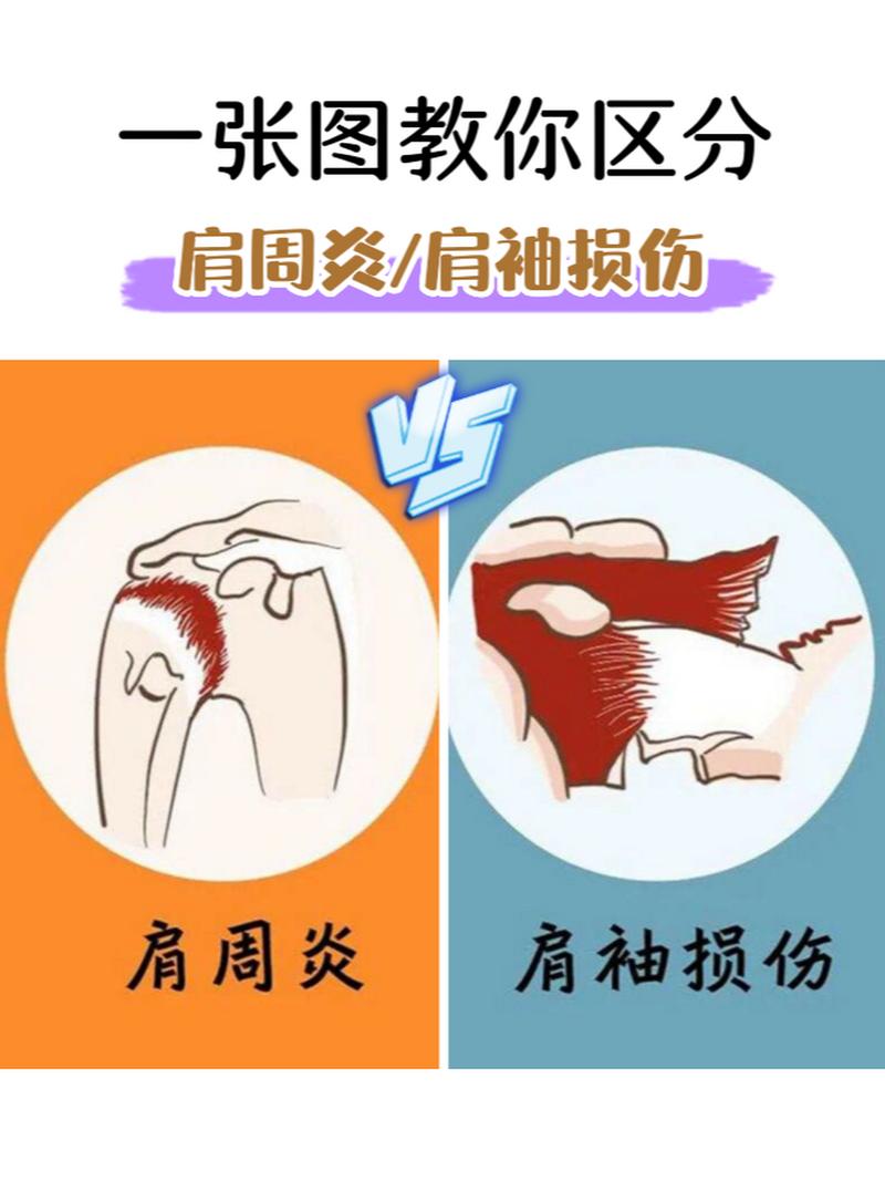 女性肩周炎症状有哪些