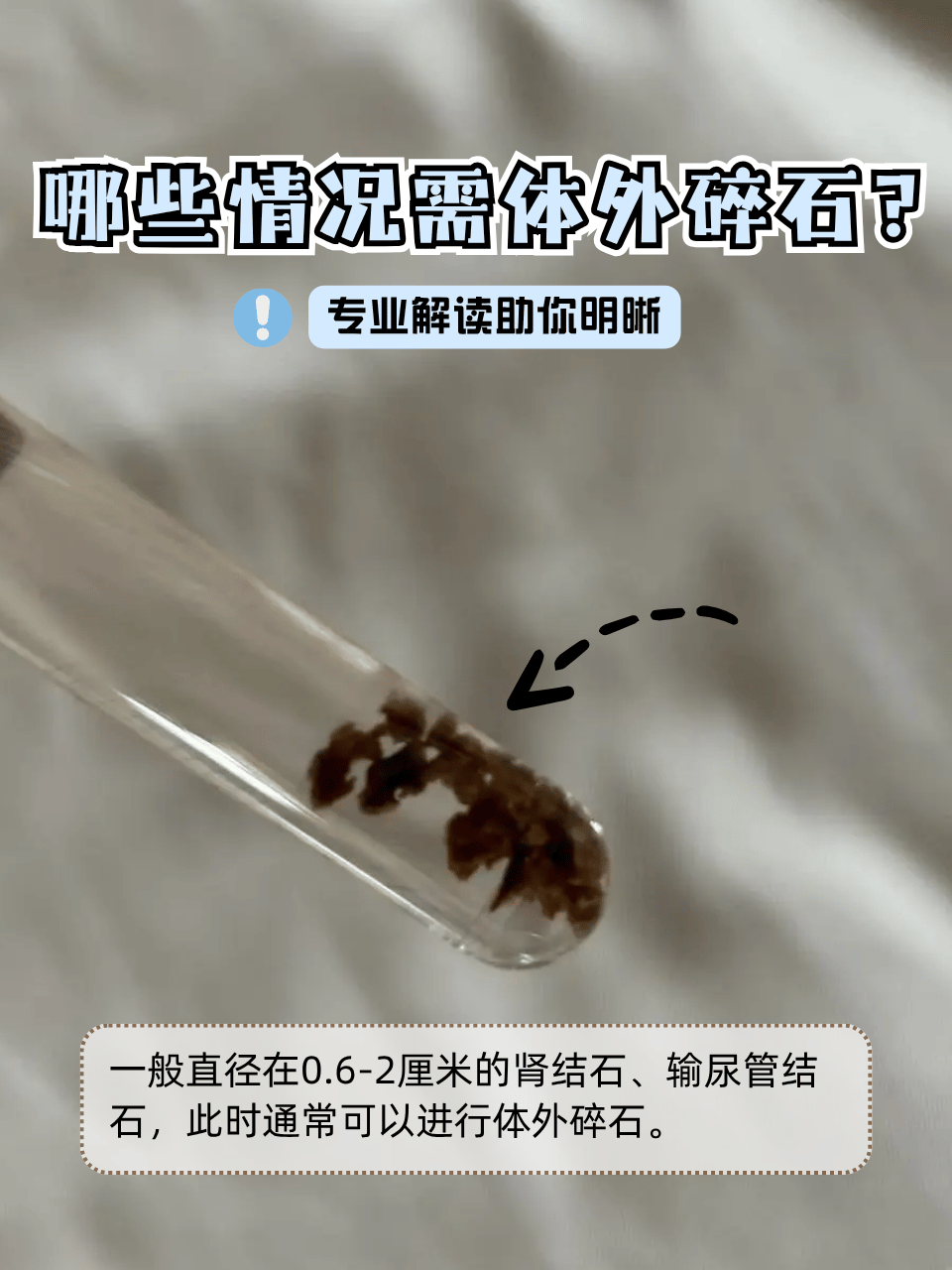肾结石能体外碎石吗?
