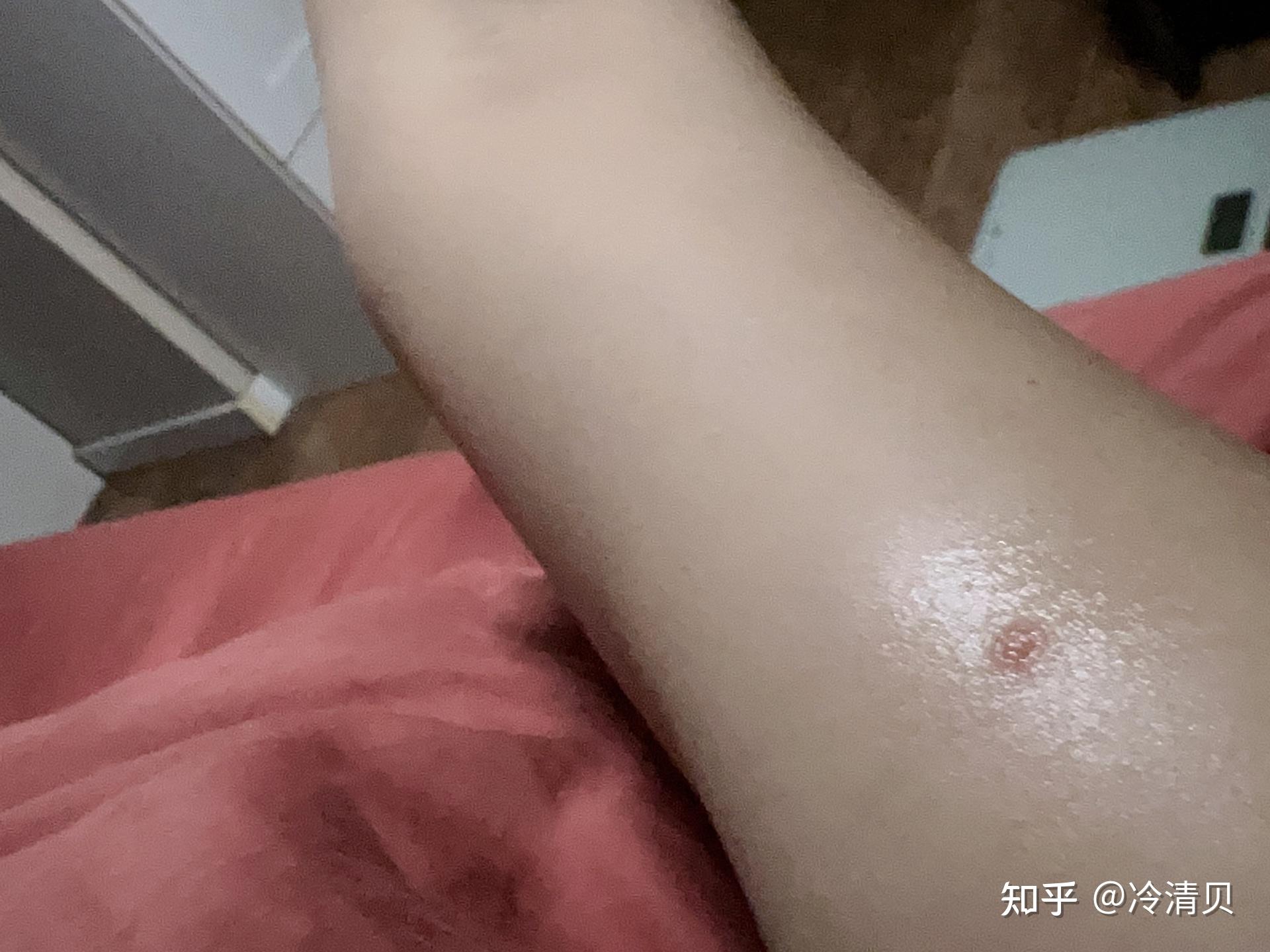 点滴型银屑病治愈三年了