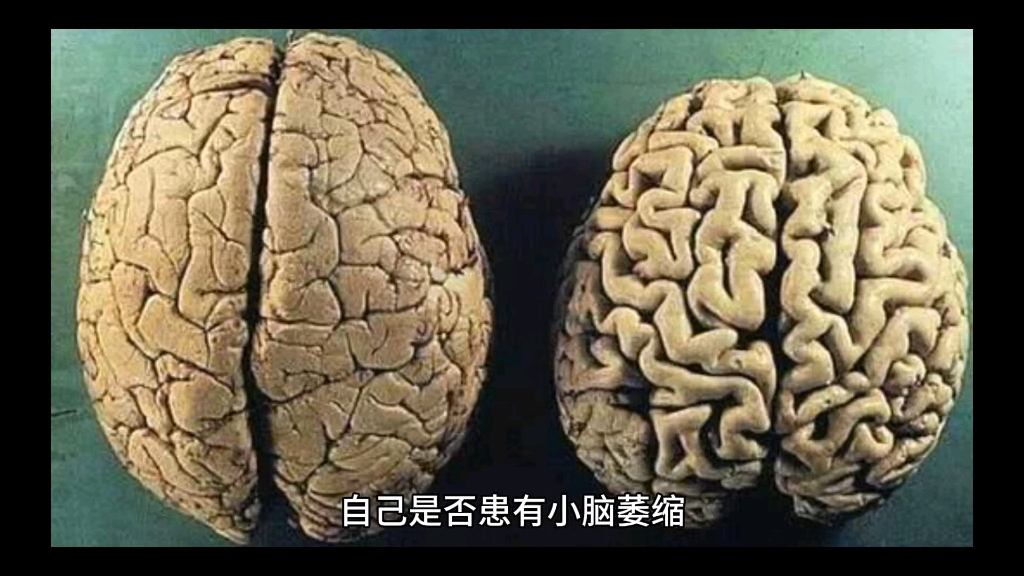 小脑萎缩的症状是什么?