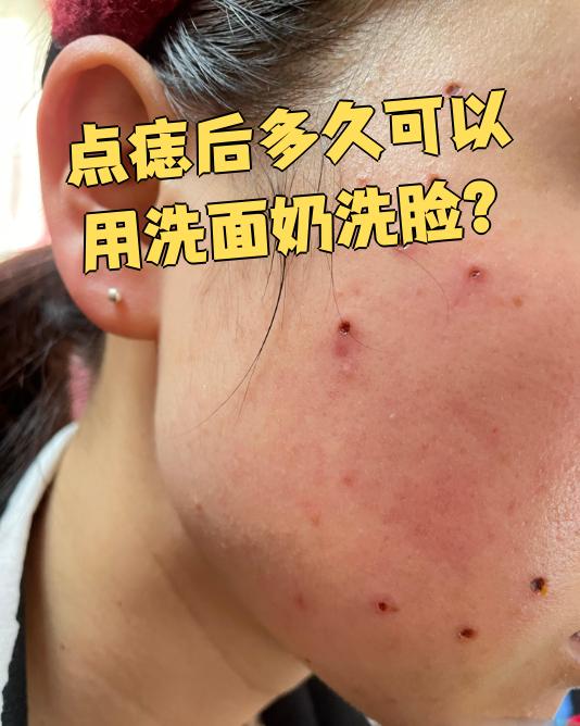 激光点痣后多久可以正常洗脸?