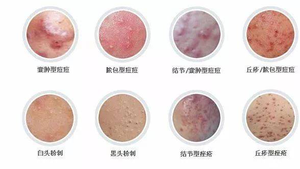 胸前长痘痘是什么原因