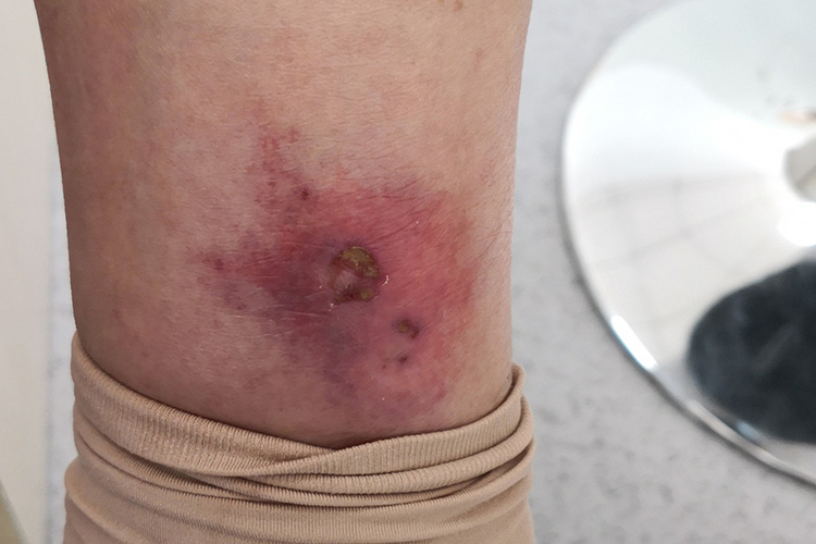 丹毒一般治疗多久能有好转?