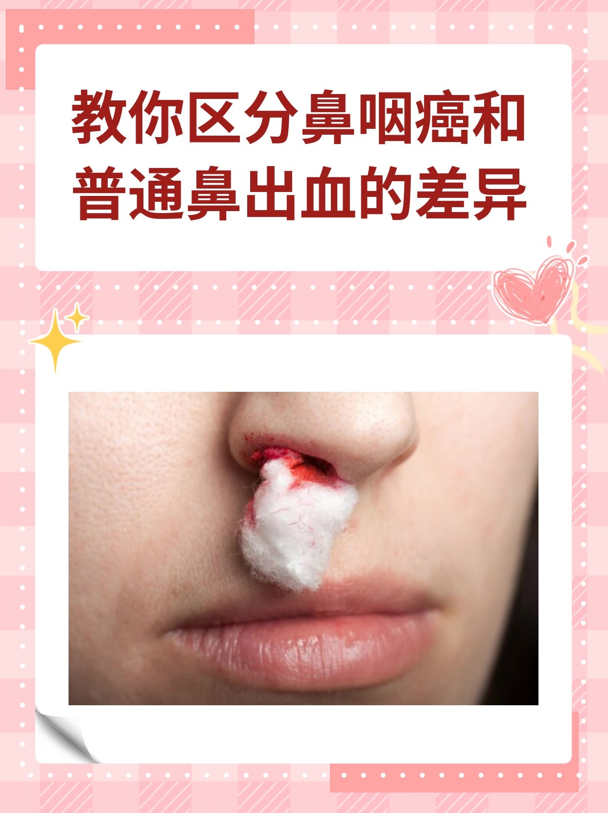 鼻腔出血但不是流鼻血是怎么回事