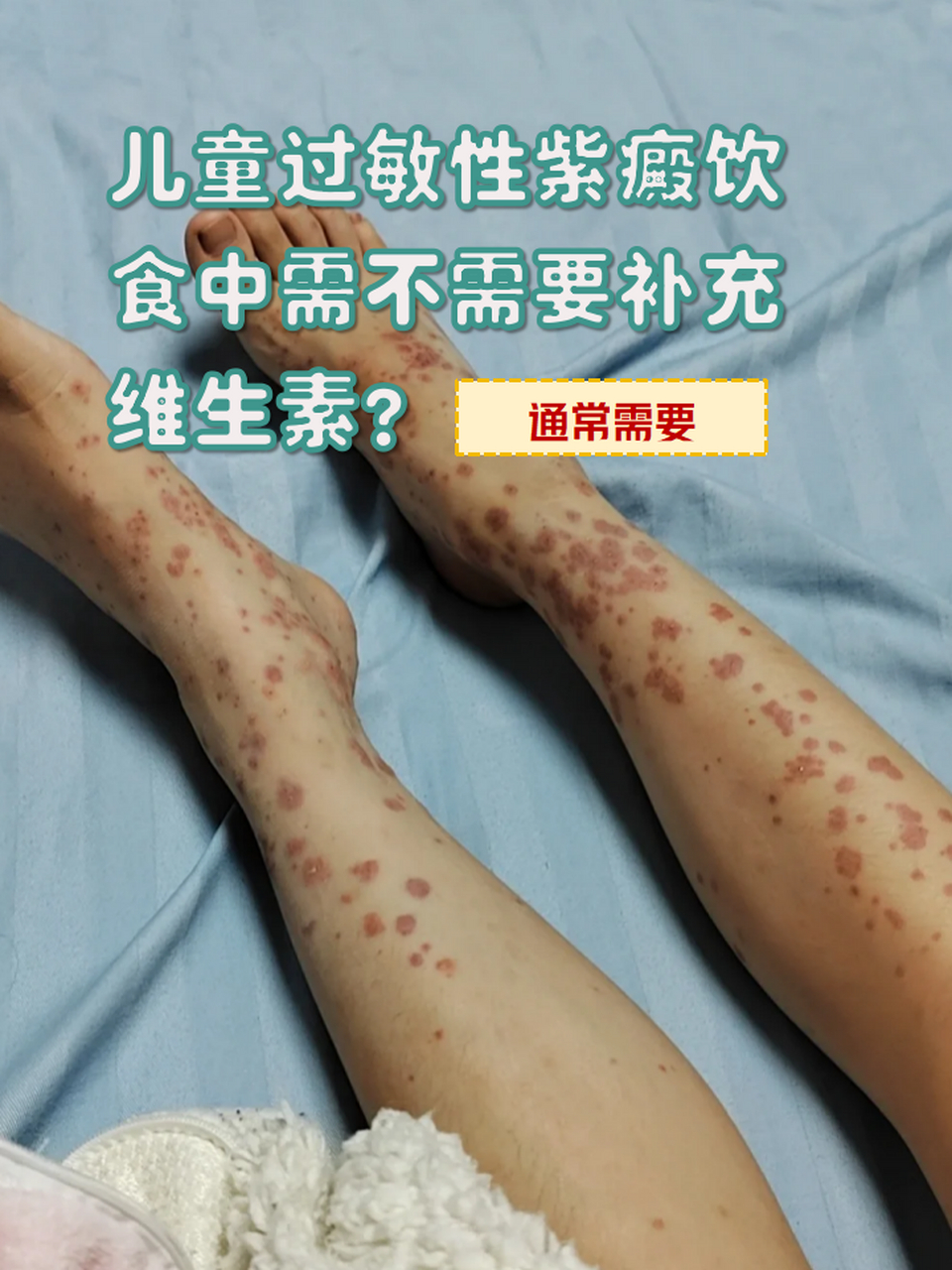 什么是紫癜病?严重吗?