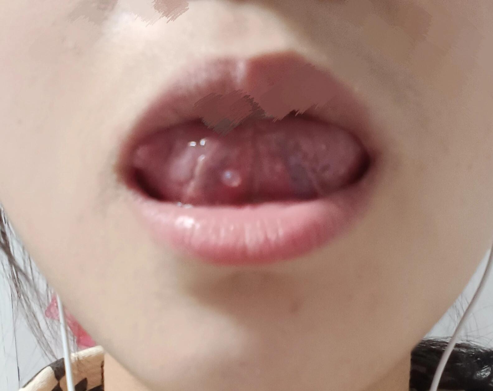 舌尖下长个小肉疙瘩是什么