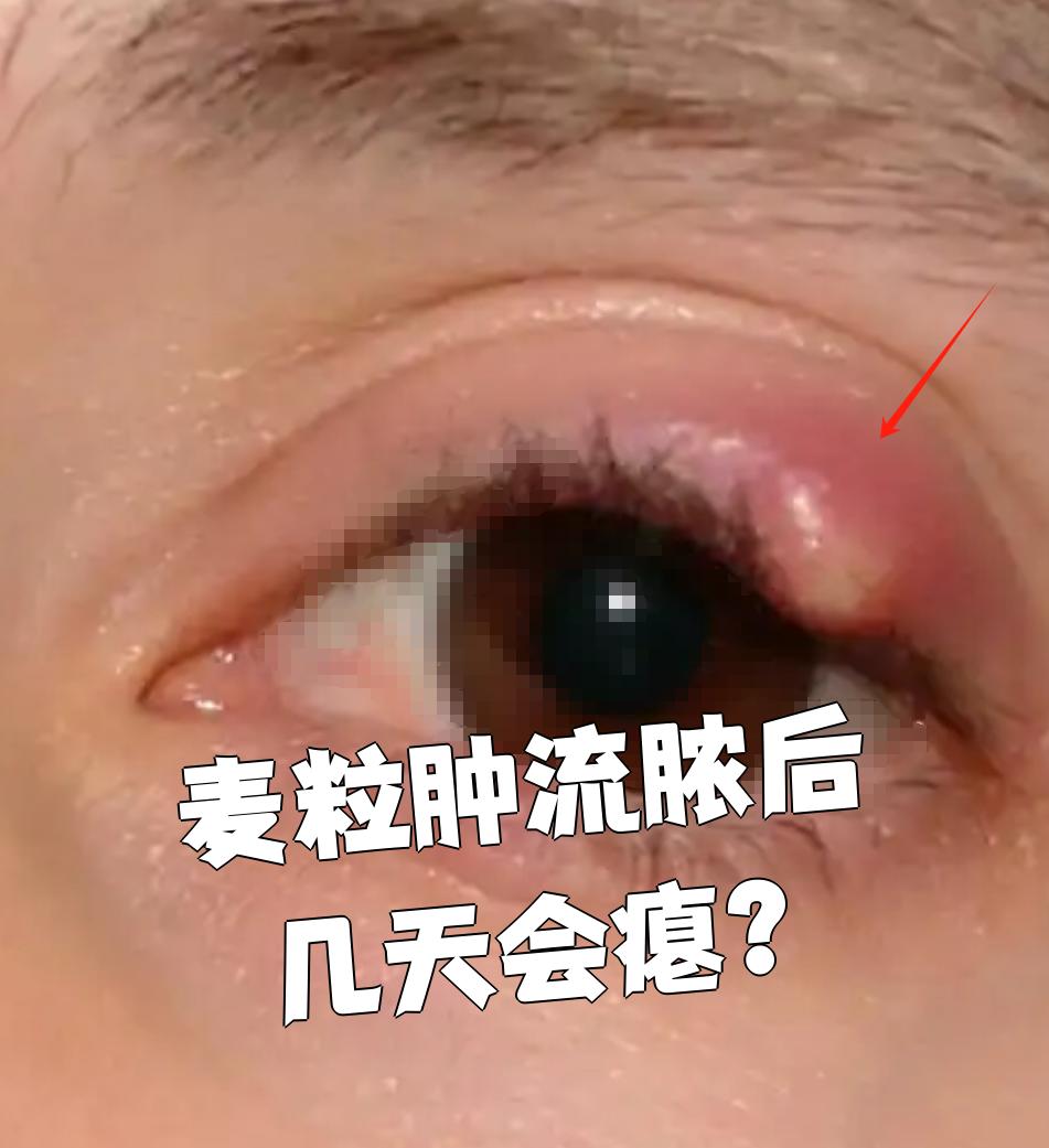 眼角肿了个包是麦粒肿吗