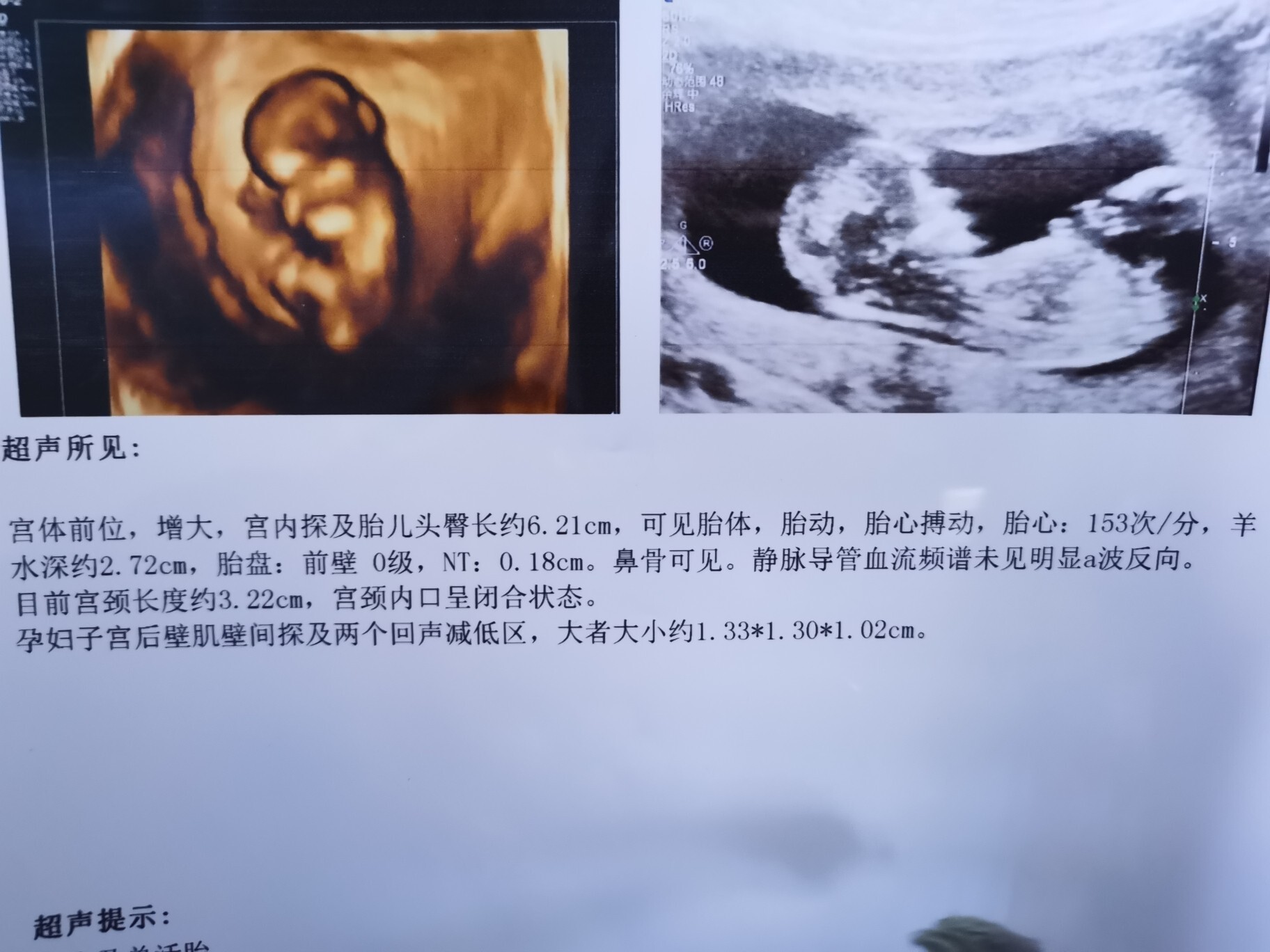 怎么通过三维彩超看男女