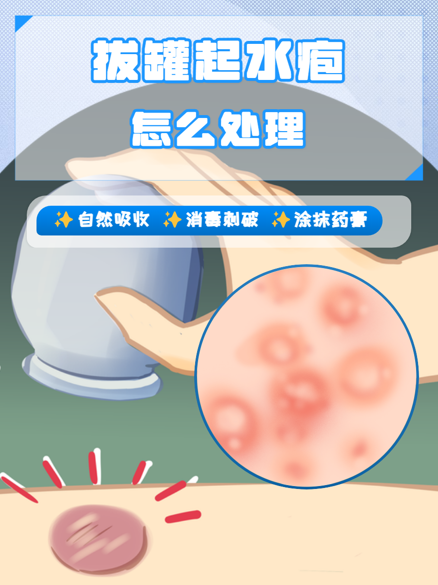 拔罐拔出水泡是好是坏