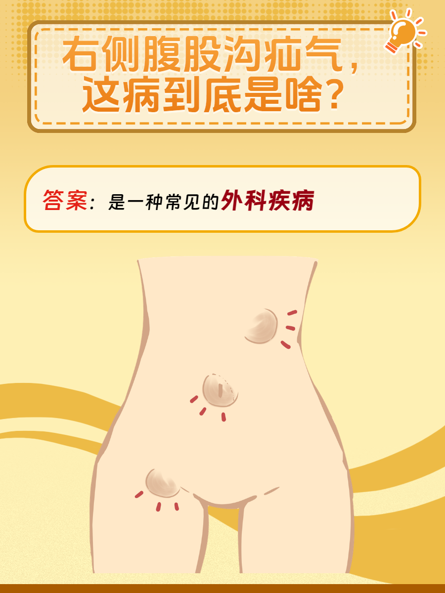 腹股沟疝科普