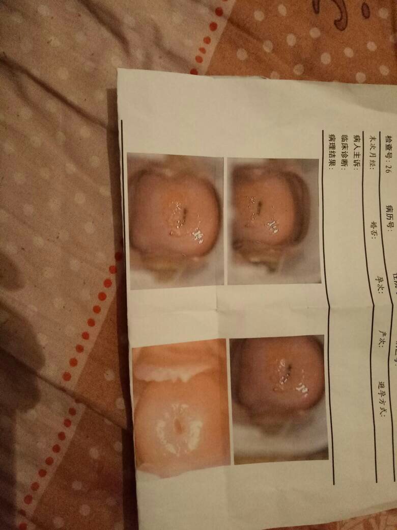 轻度宫颈糜烂