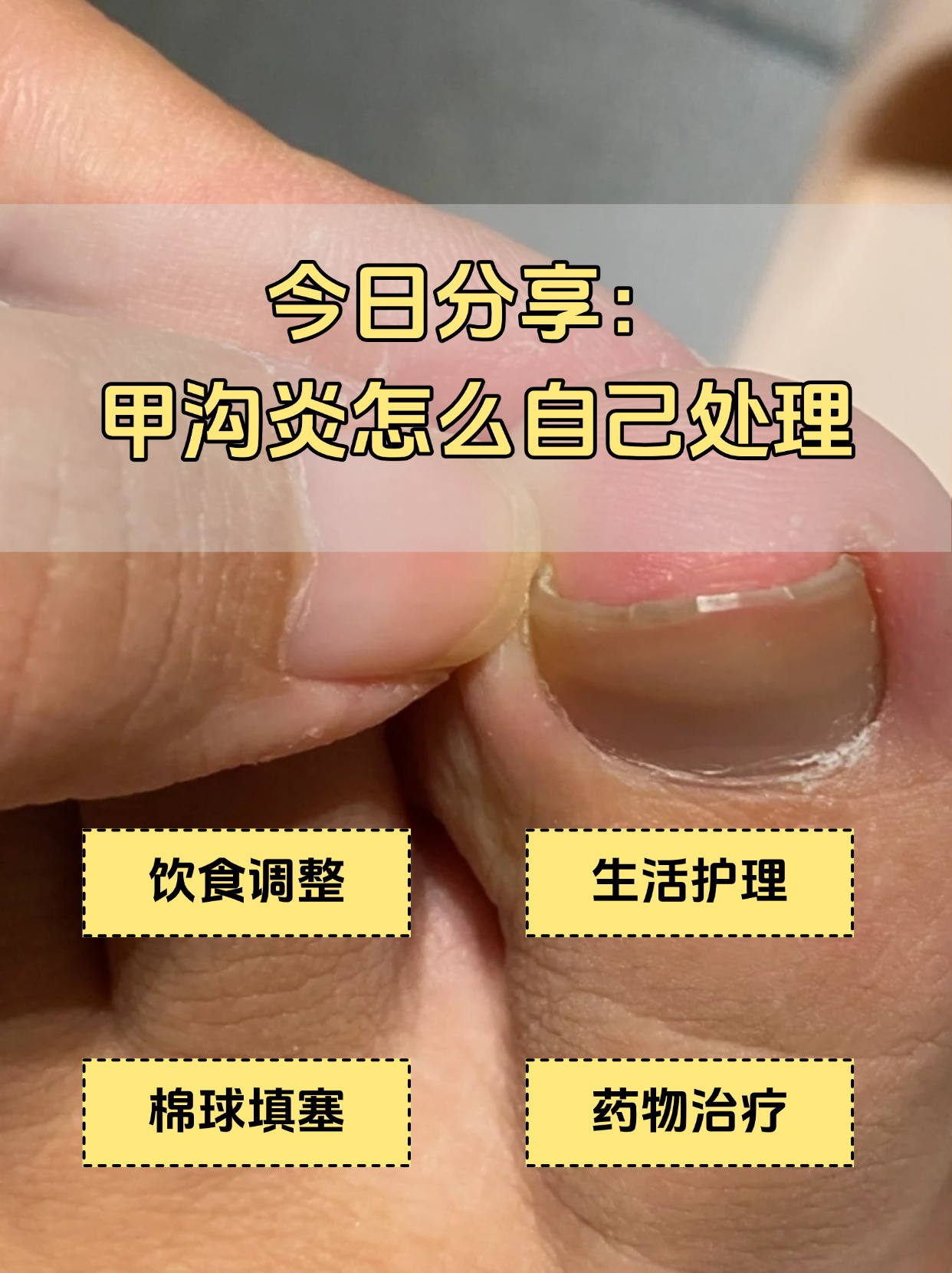 甲沟炎该如何自己治疗