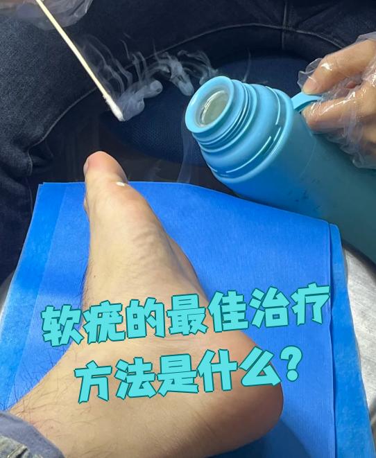病毒性软疣的最好治疗方法