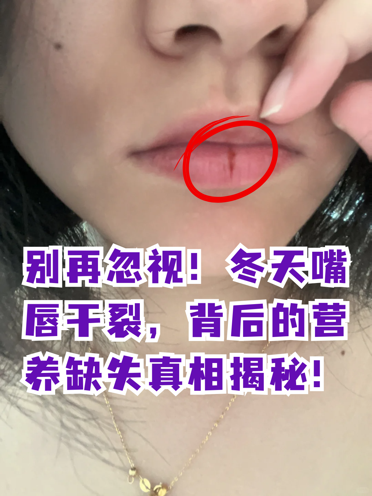 嘴唇起皮是什么原因?