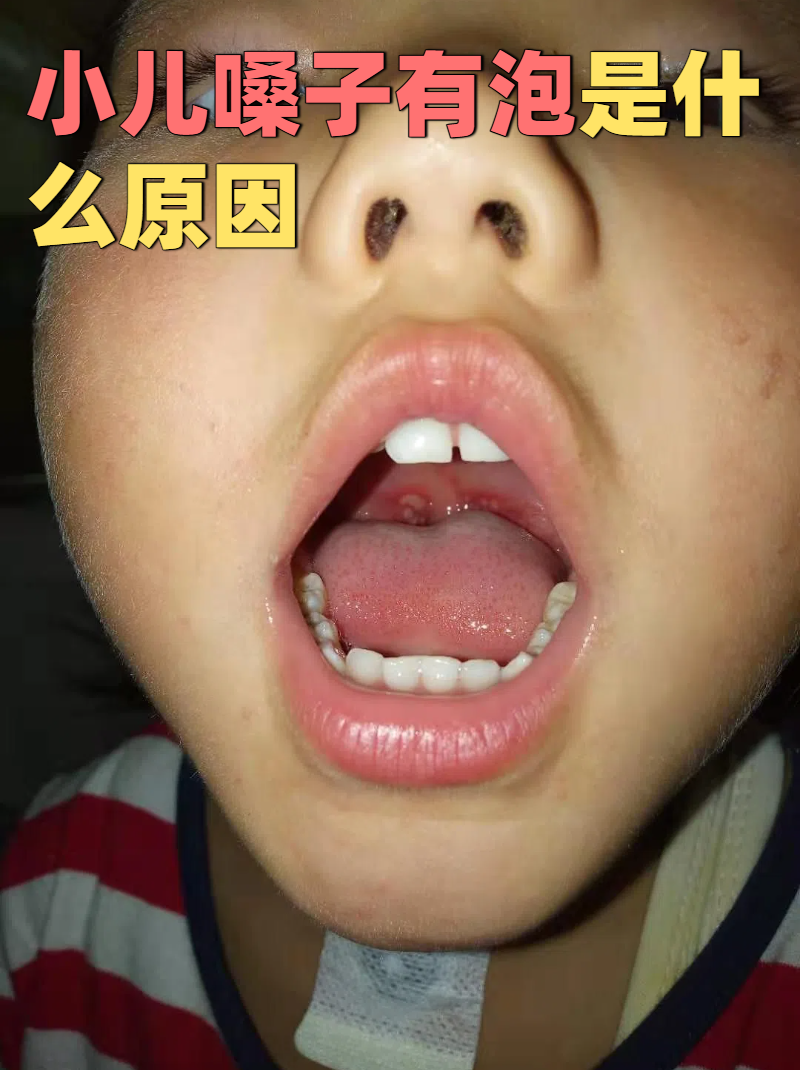 嗓子长泡泡