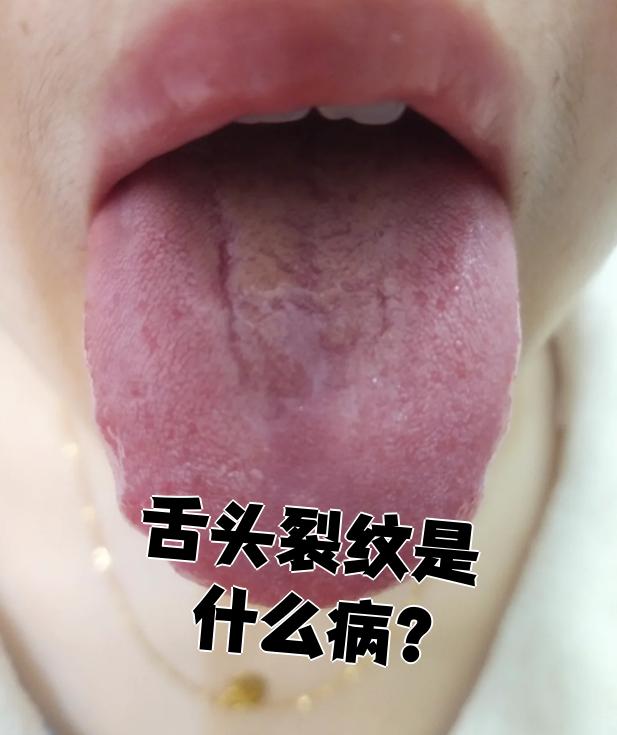 舌头上有裂缝是什么病?