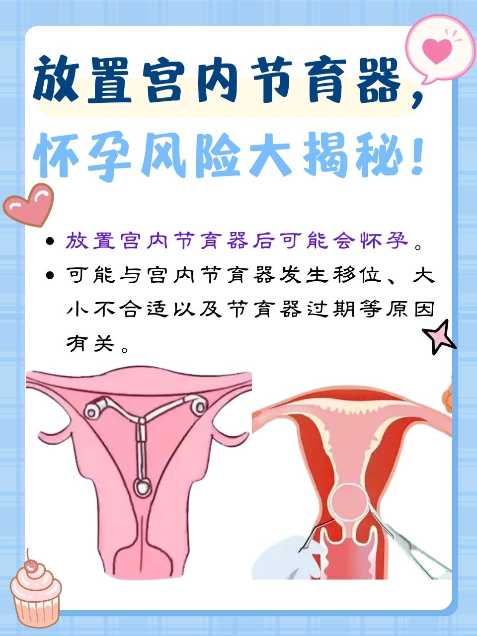 上环会怀孕吗?