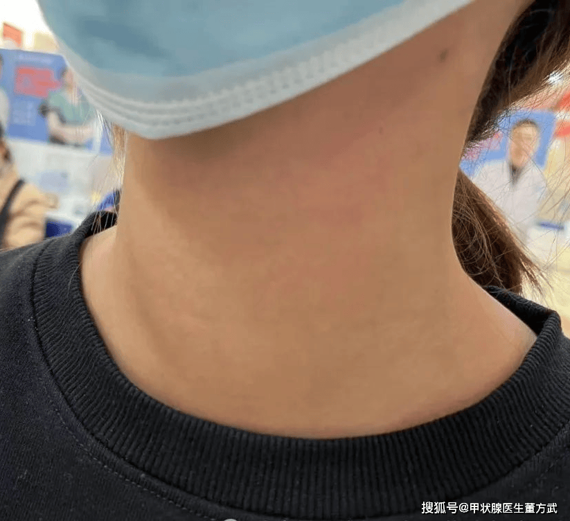 甲亢症状表现