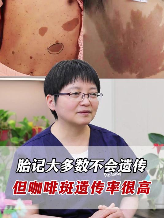 胎记会遗传吗