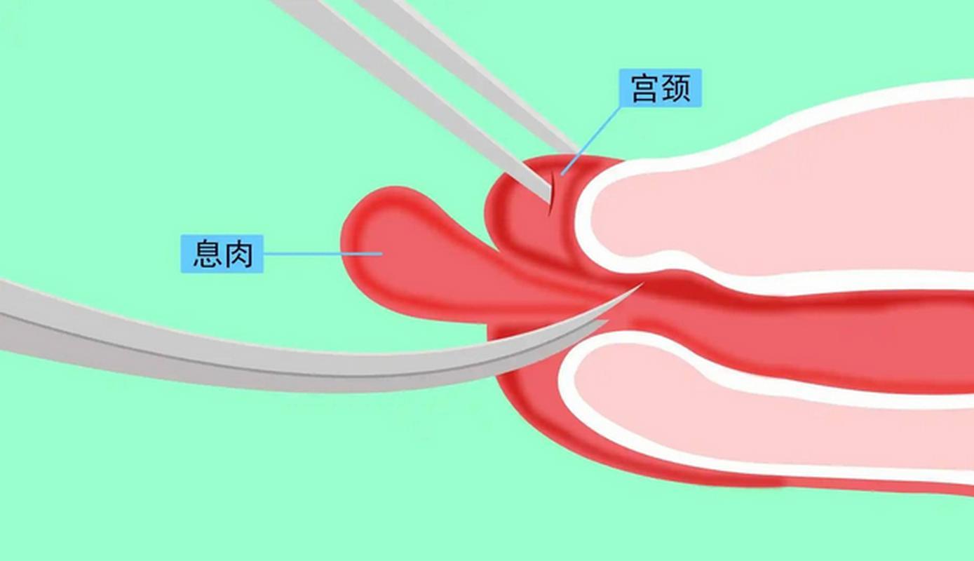 宫颈息肉的症状有哪些