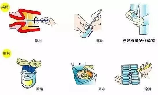 宫颈刮片检查需要注意什么