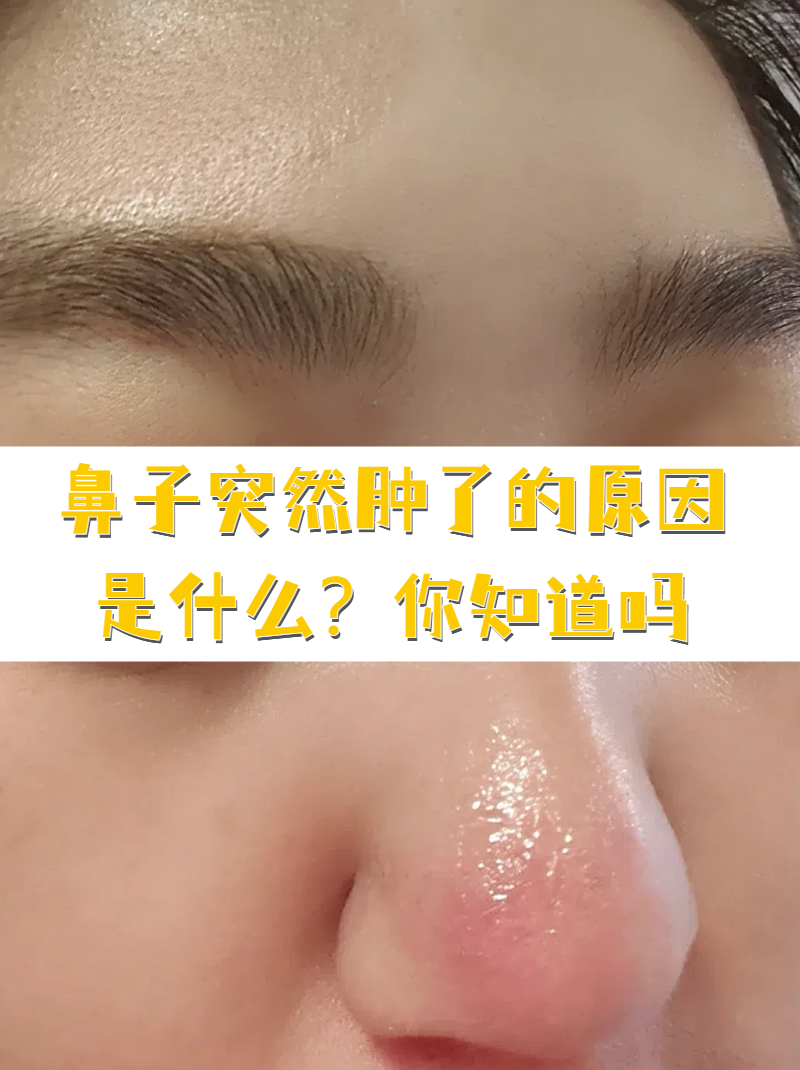 鼻子上长痘痘又红又肿怎么办