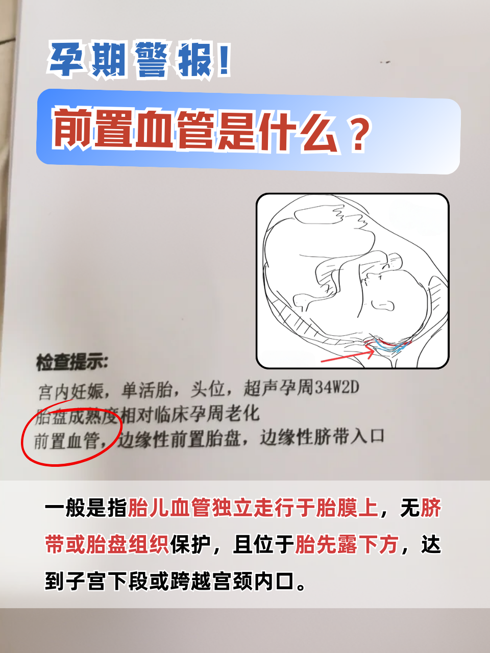 cdfi可见血流信号是什么意思