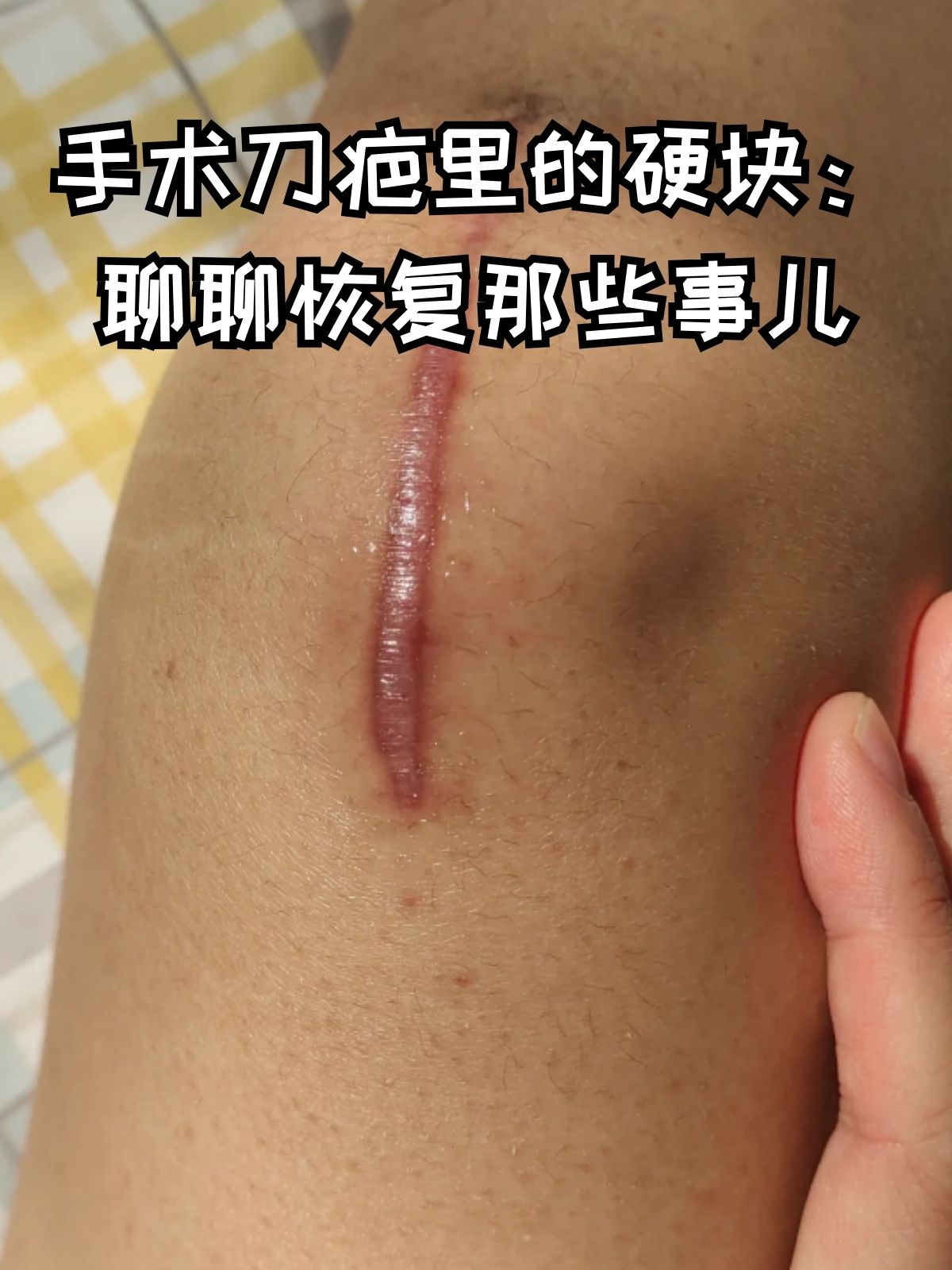 手术线头在肉里怎么办