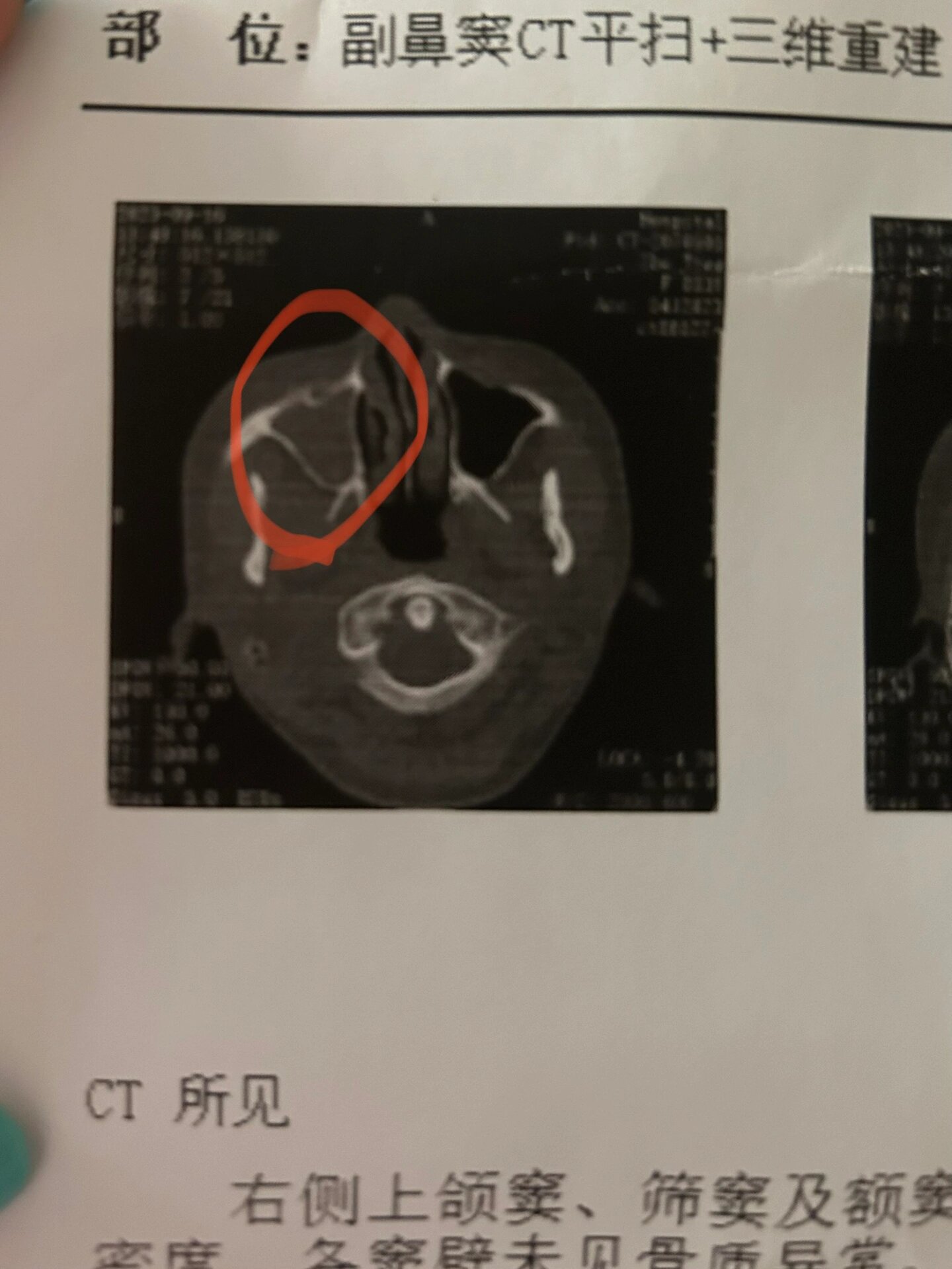 双侧上颌窦炎能自愈吗