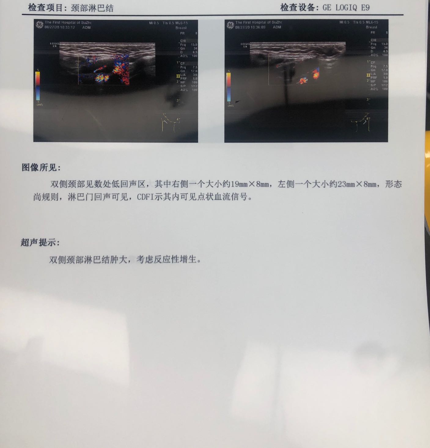 良性淋巴结的彩超特征是什么