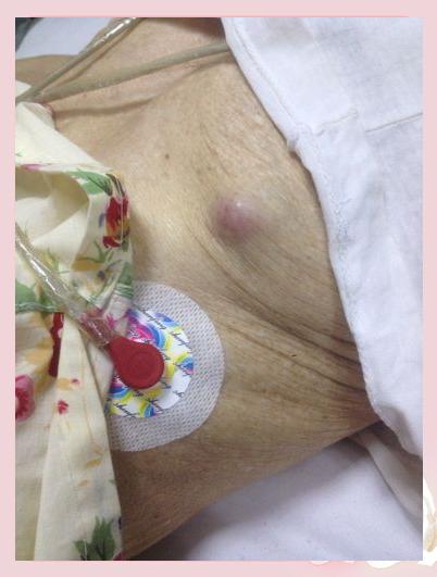 胸部有硬块正常吗