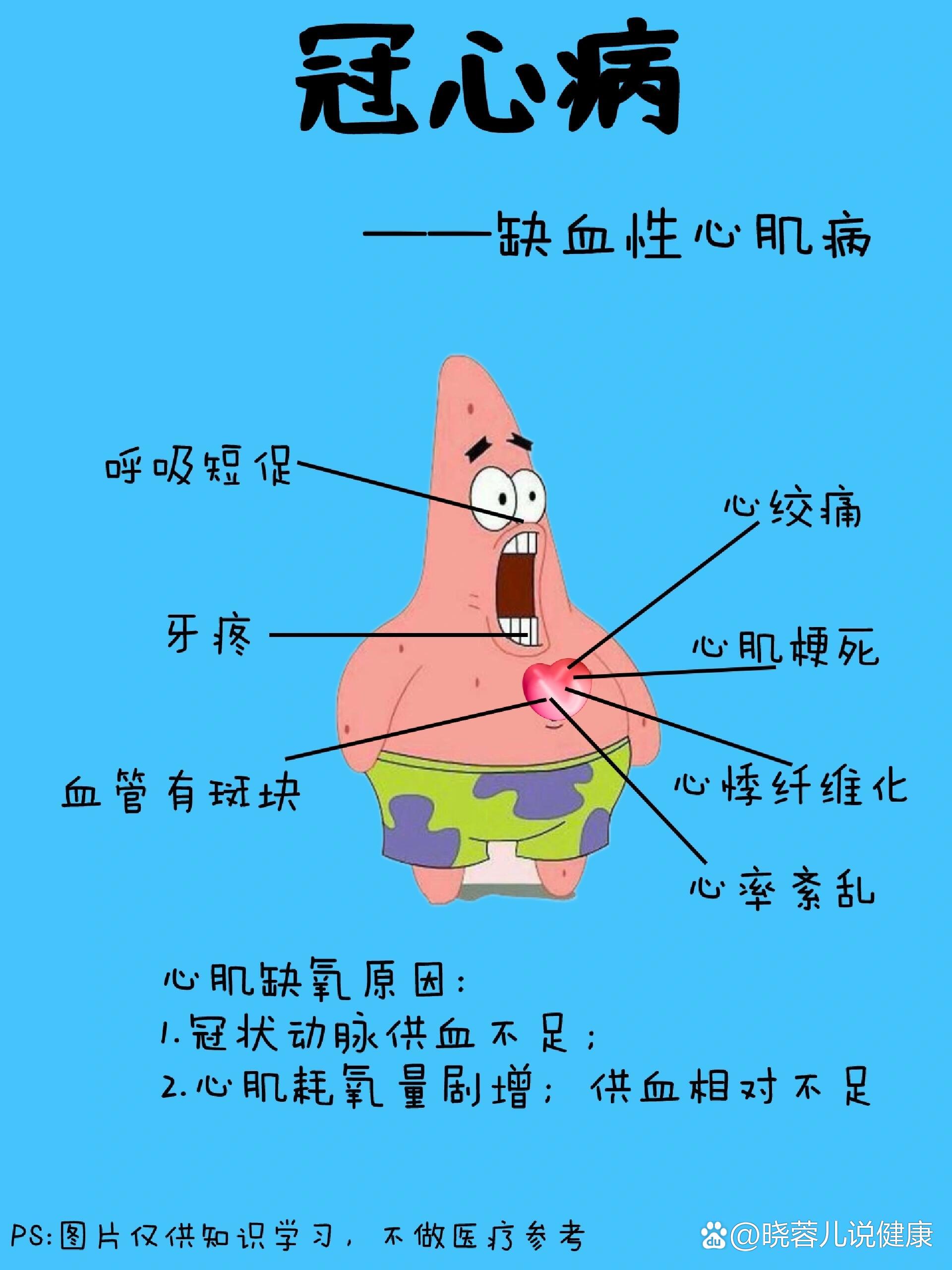 冠心病的病因产生
