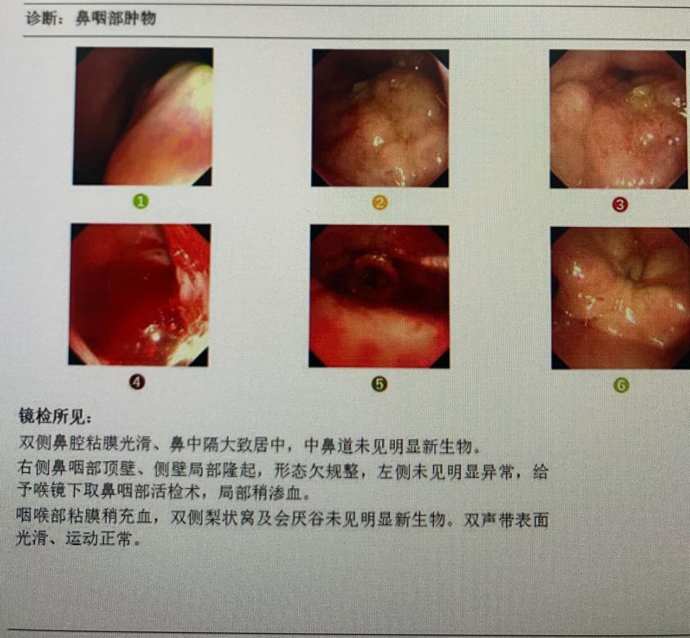 怎么检查自己是不是得了鼻咽癌?