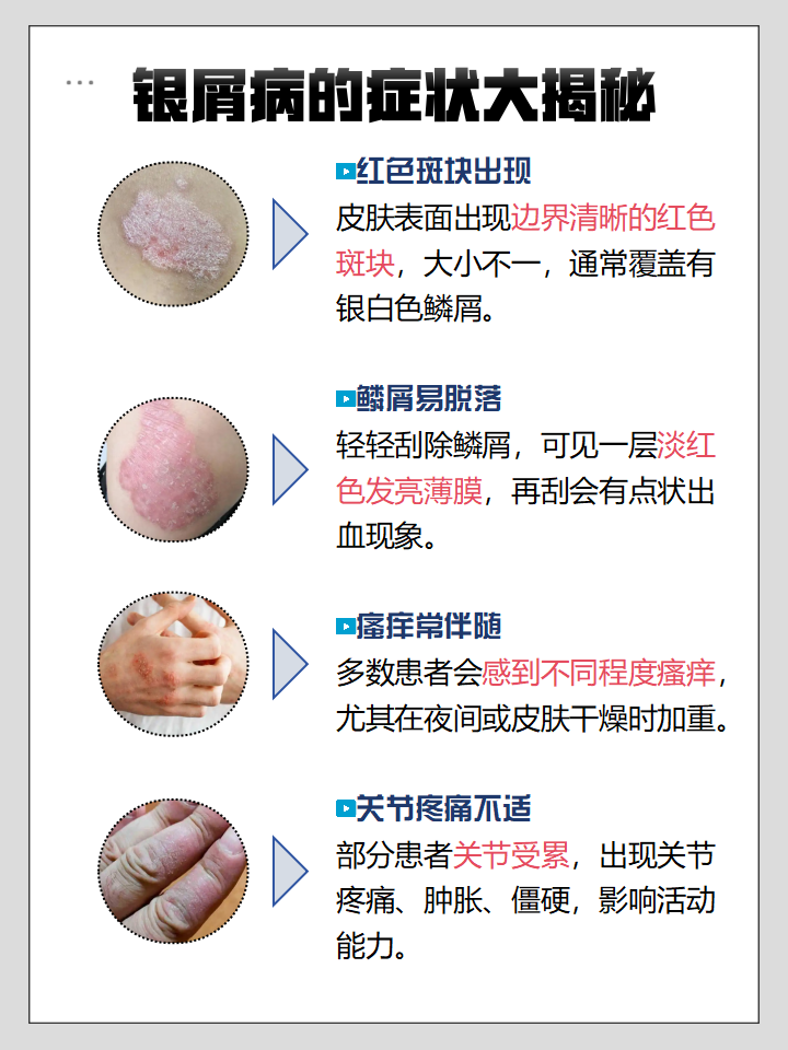 银屑病是怎么得的?