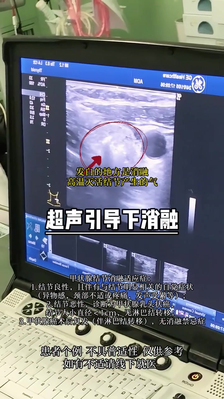甲状腺双侧叶囊性小结节严重吗?
