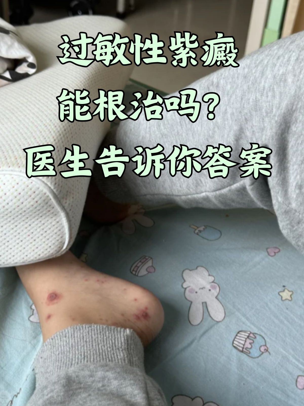 紫癜病怎么治疗疗效好