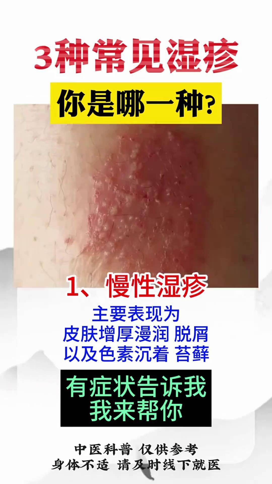 成年人湿疹怎么治