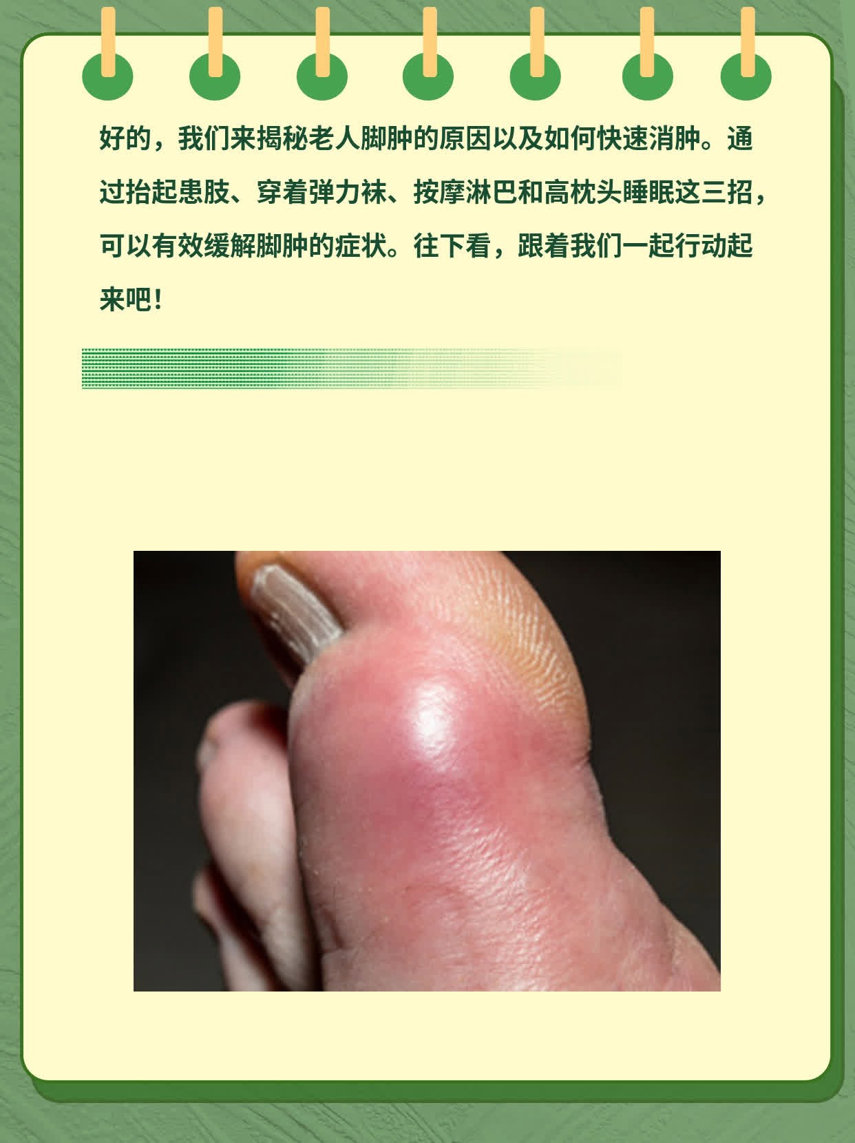 糖尿病人脚肿怎么消肿