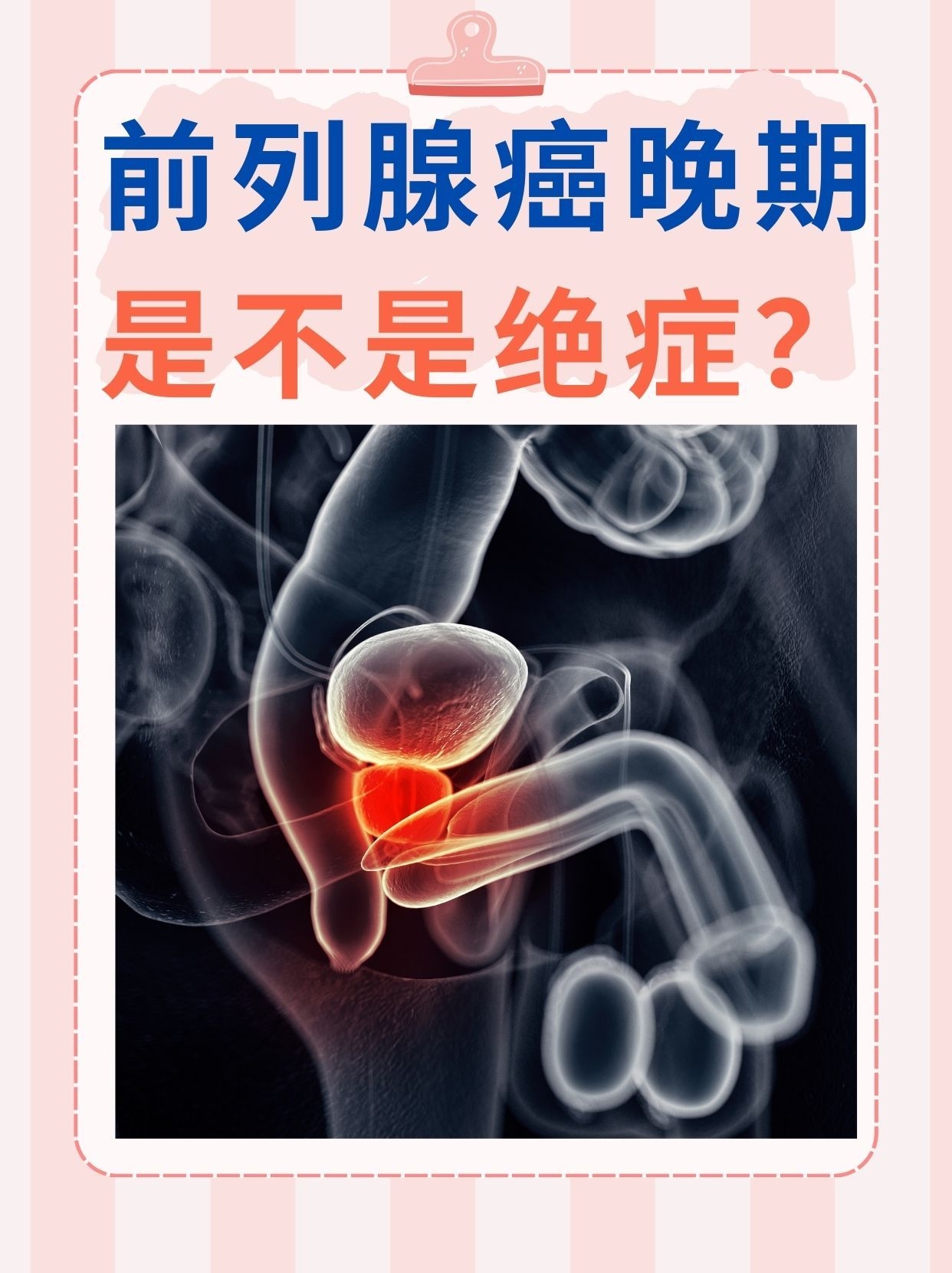 前列腺癌是什么病?