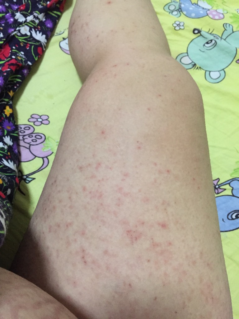 胆汁酸过高有哪些症状