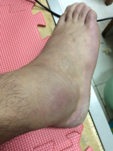 崴脚能用热水泡吗