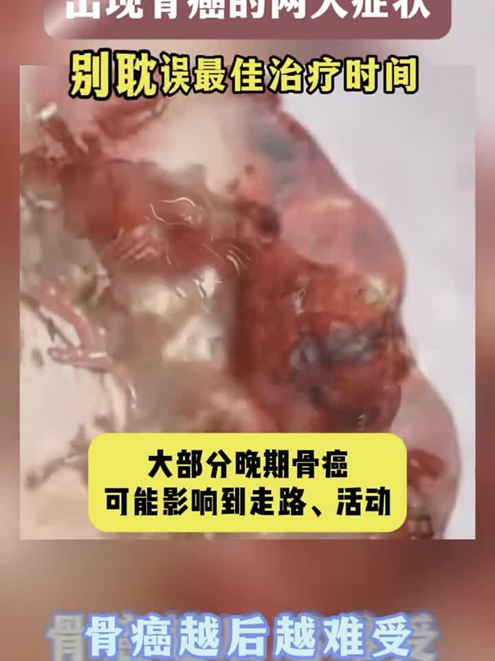 骨癌的具体症状有哪些