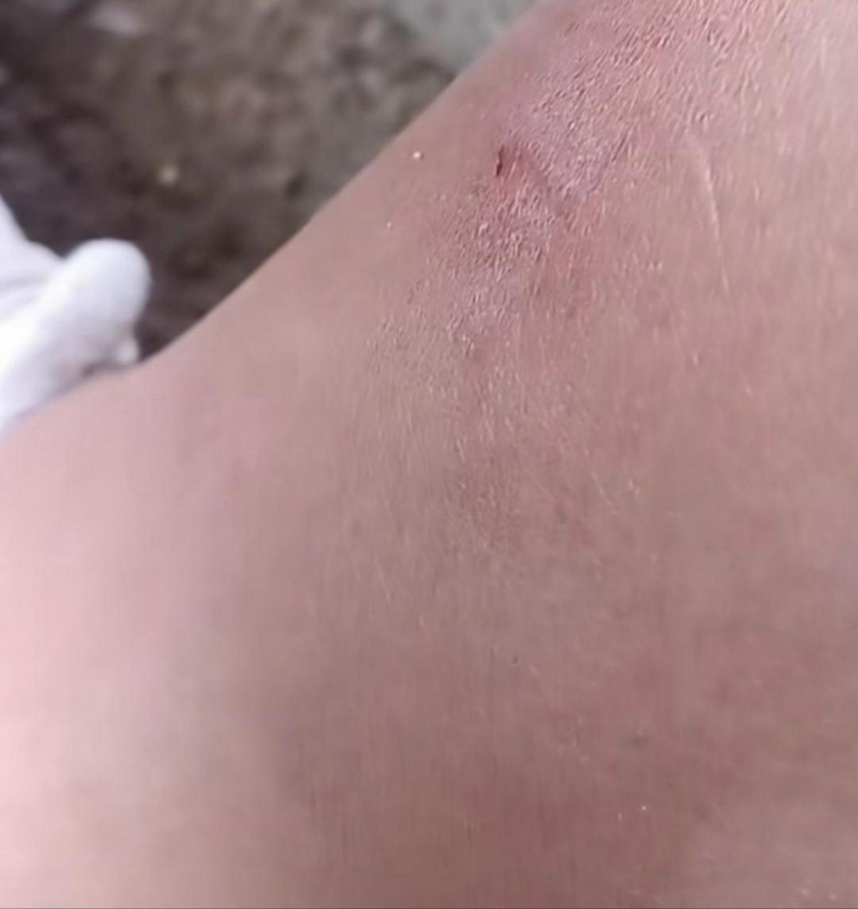 身上有虫子爬的感觉