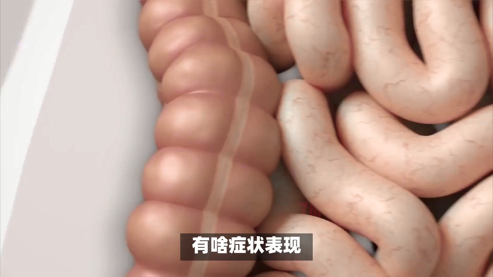 肠激惹综合征症状有哪些
