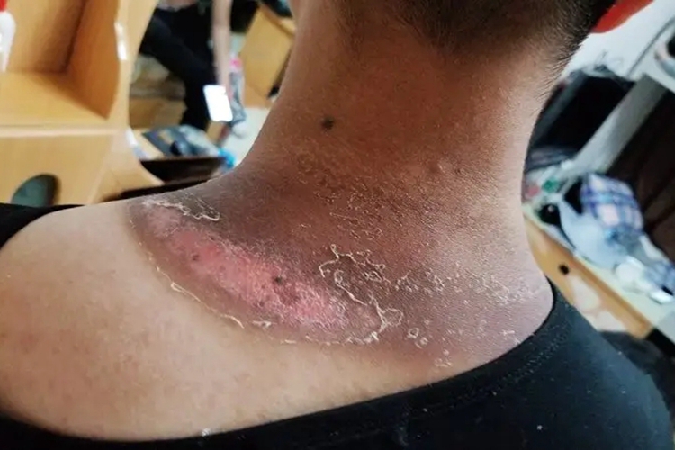 日光性皮炎能根治吗?