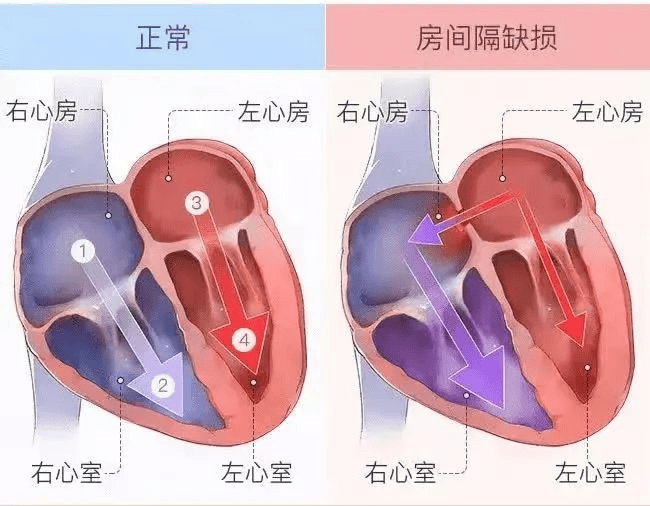 什么是房间隔缺损?